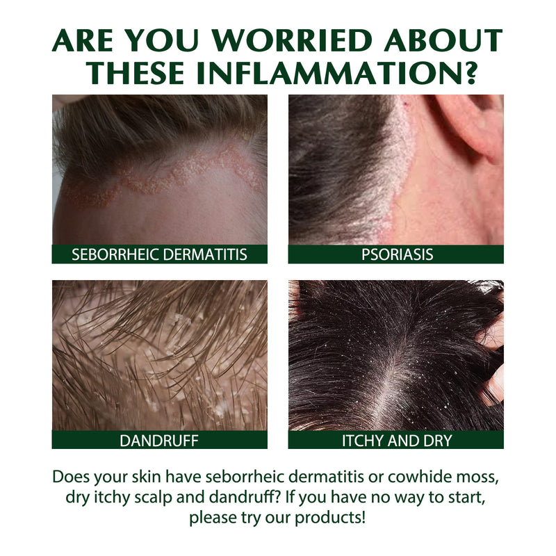 Tinea Scalp Care Shampoo