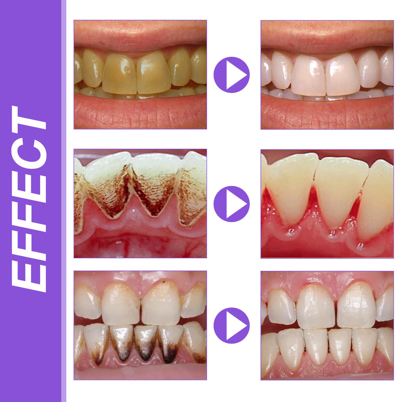 OUHOE Teeth Whitening Essence